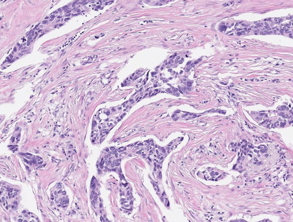 Cancerous cells (colored in dark purple) are visible in this slide using Nucleai's platform. Photo: Nucleai Cancerous cells (colored in dark purple) are visible in this slide using Nucleai's platform. Photo: Nucleai