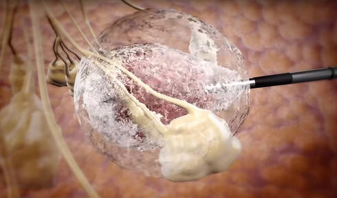 הדמייה של גידול סרטני קופא, אייסקיור. טכנולוגיה מצילת חיים, הדמיה: אייסקיור