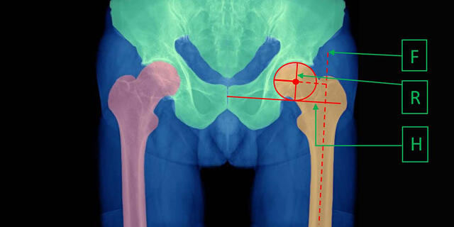 Hip Replacement Rsip vision