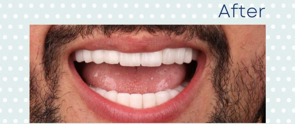  Fly Dent- השתלות שיניים וניתוחים אסתטיים